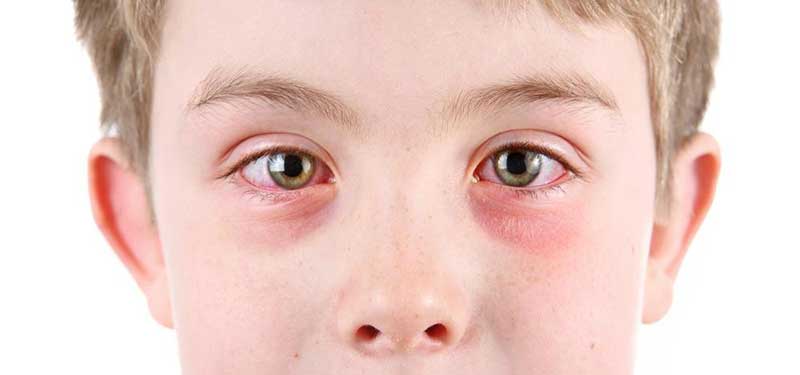 Understanding the Causes of Eye Inflammation