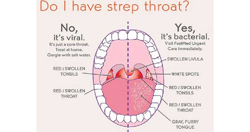 Effective Home Remedies for Sore Throat